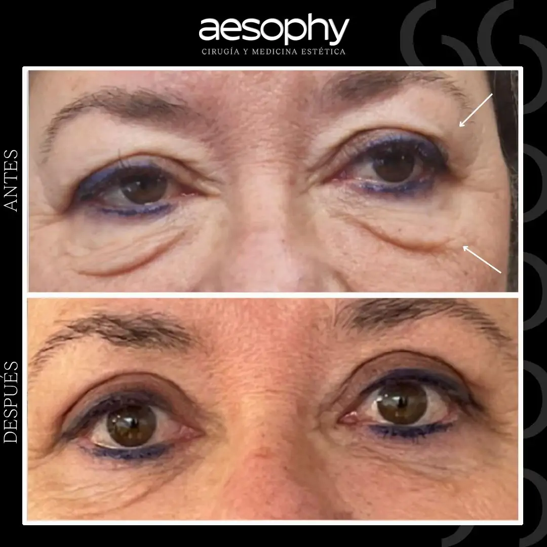 Blefaroplastia en Málaga: Cirugía Estética para Rejuvenecer tu Mirada